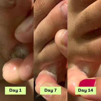 NEGUSY™ Tea Tree Athlete's Foot Defense Soap