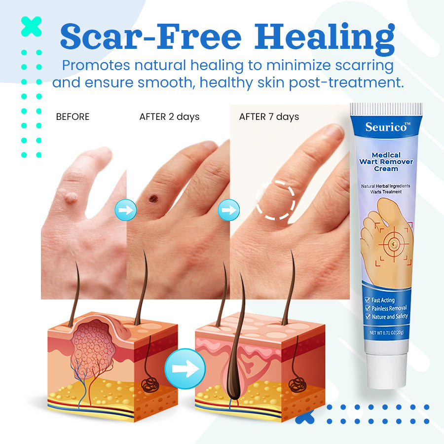 Seurico™ Medical Wart Removal Cream