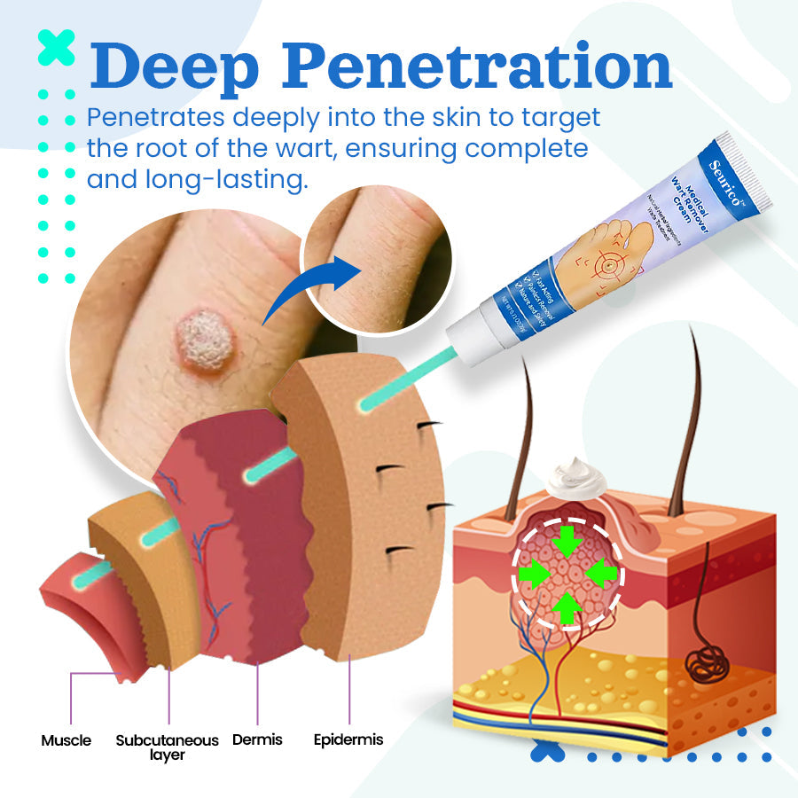Seurico™ Medical Wart Removal Cream